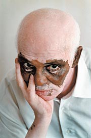 Vitiligo Treatment